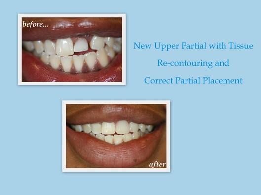 new upper partial denture with tissue recontouring and correct partial placement