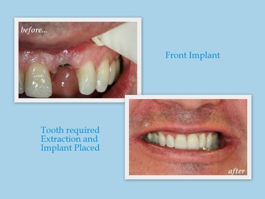 front implant