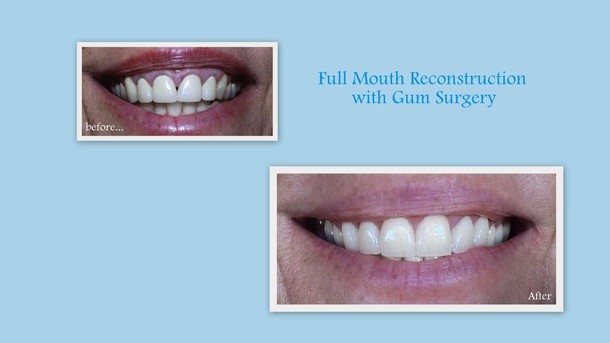 Full mouth reconstruction with gum surgery